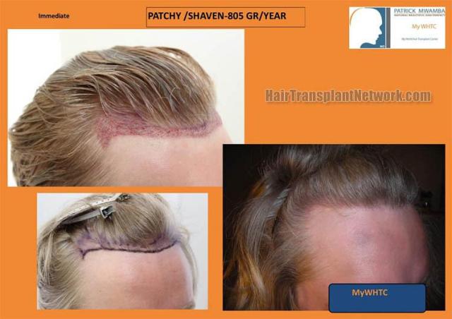 Hair transplantation surgery before and after photos