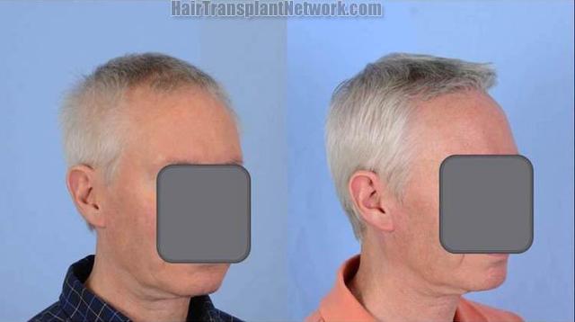 Hair restoration procedure before and after results