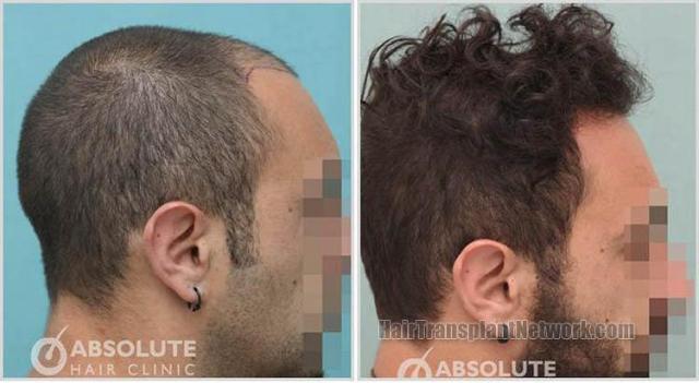 Hair transplantation surgery before and after images