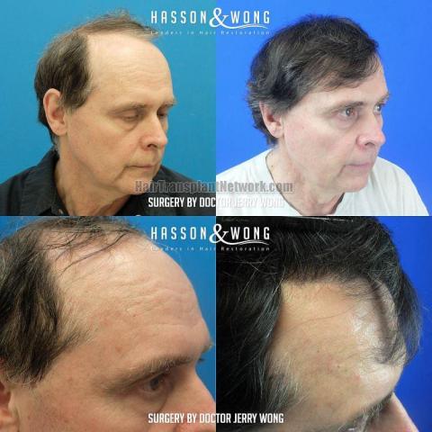 Hair transplantation procedure before and after results