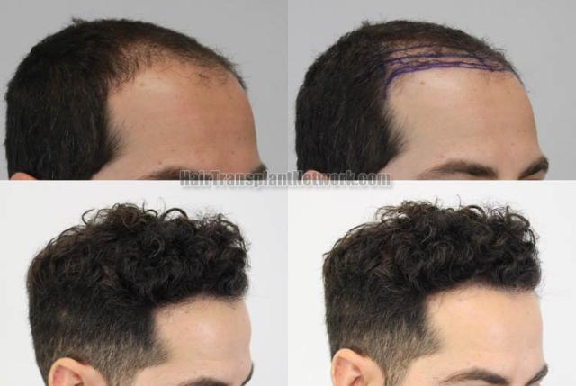 Hair restoration procedure after result images