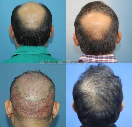 Surgical hair transplantation result photographs