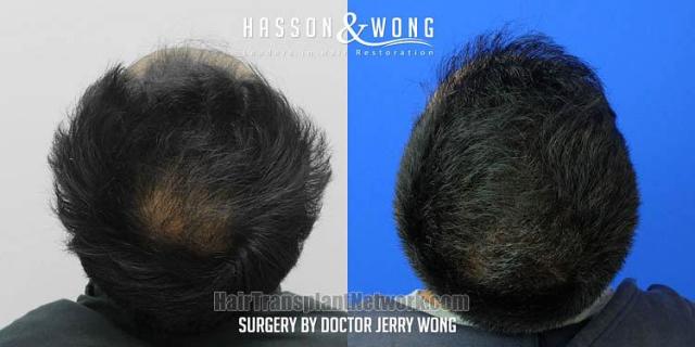 Surgical hair transplantation result photographs