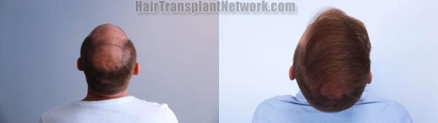 Surgical hair transplantation result photographs