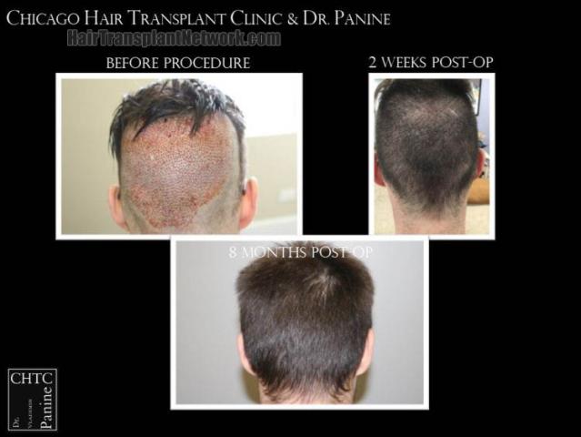 Surgical hair transplantation result photographs