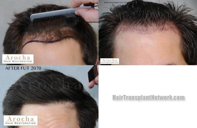 Hair transplantation surgery before and after photos