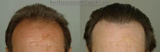 Hair transplantation surgery before and after images