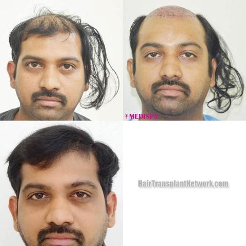 Before and after hair restoration procedure images