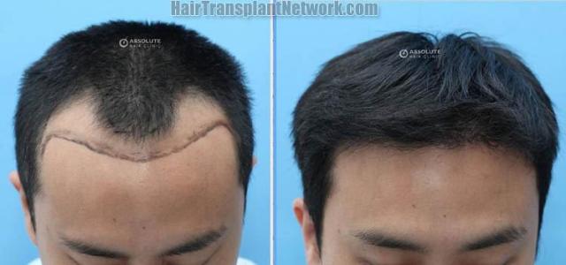 Front view - Before and after eyebrow transplant surgery