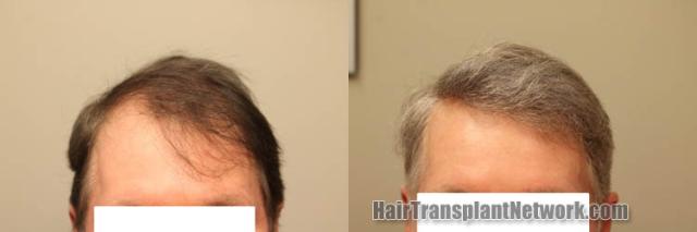 Front view - Before and after hair restoration procedure