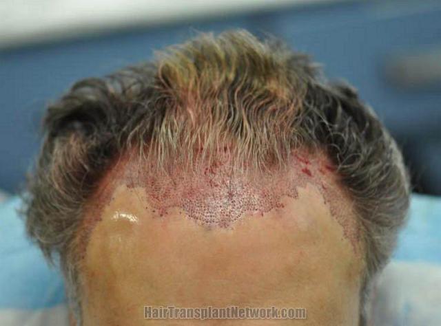 Hair transplant surgery results immediate postoperative