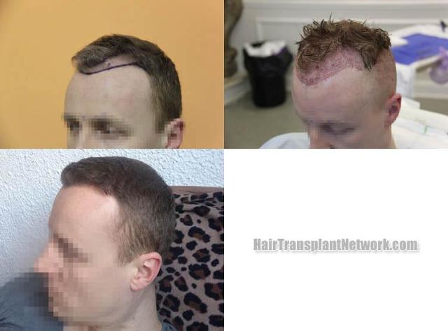 Hair transplantation surgery before and after images