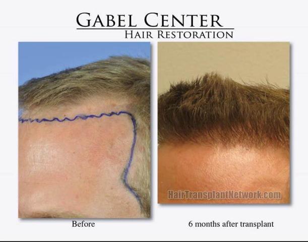 Hair restoration surgery before and after photos