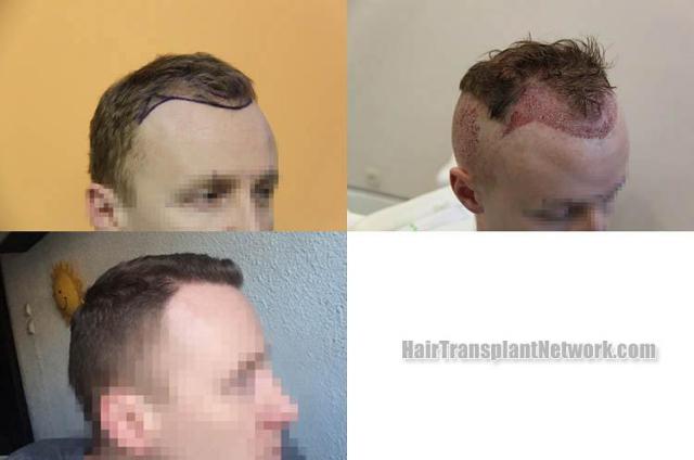 Hair transplantation surgery before and after photos