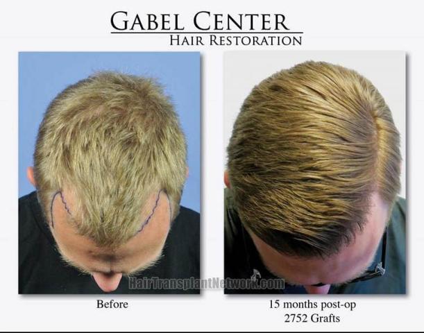 Hair transplantation surgery before and after photos