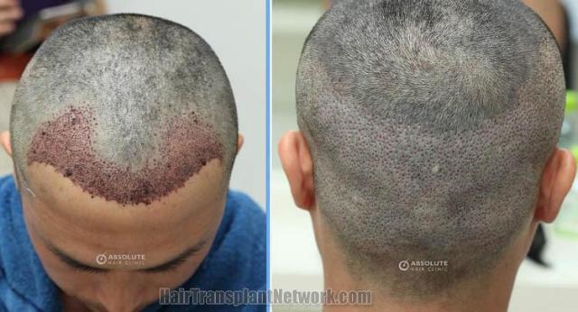 Surgical hair transplantation result photographs