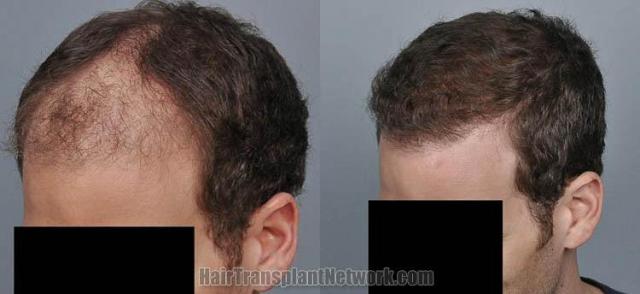 Hair transplantation surgery before and after images