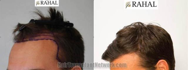 Hair transplantation surgery before and after images