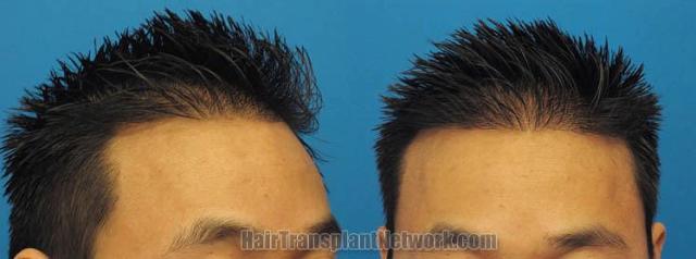 Hair restoration surgery before and after images