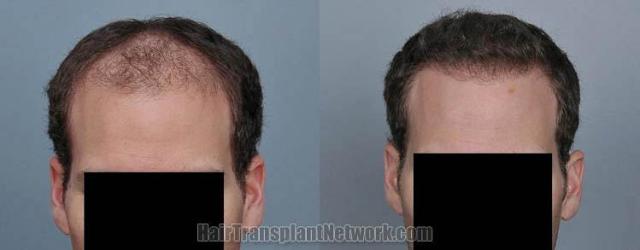 Before and after hair transplant procedure images