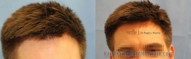 Hair transplantation surgery before and after images