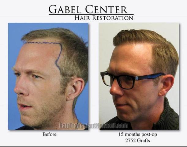 Hair transplantation surgery before and after pictures