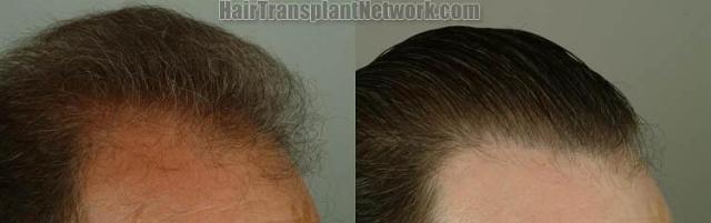 Hair restoration procedure before and after pictures