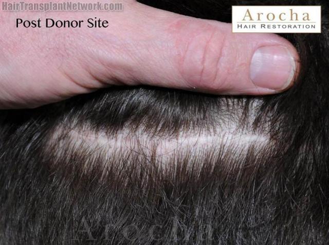 Hair restoration procedure before and after pictures