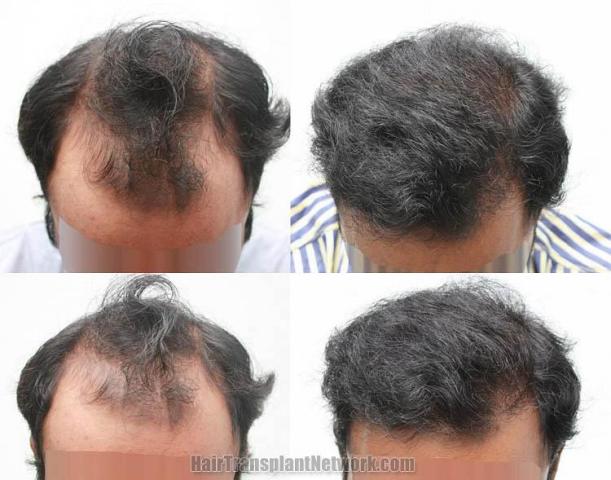 Top view before and after hair restoration results