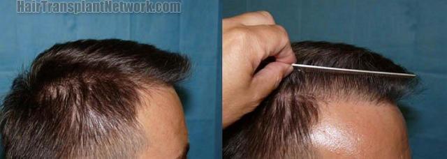 Right view before and after hair restoration procedure