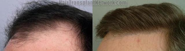 Right view before and after hair restoration procedure