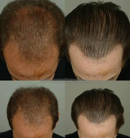 Hair transplantation surgery before and after pictures