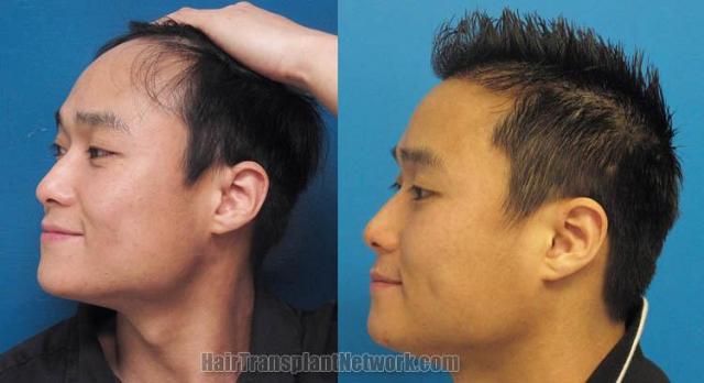 Hair transplantation surgery before and after photos