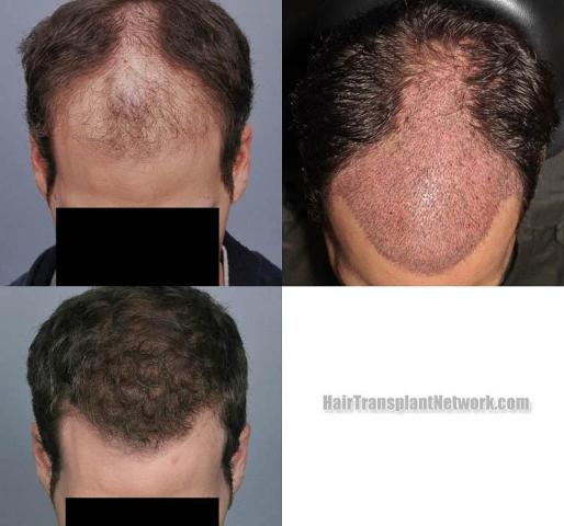 Top view before and after hair restoration results