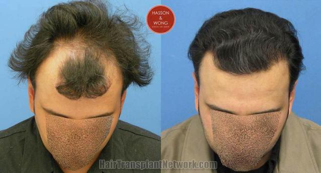 Top view - Before and after surgical hair replacement