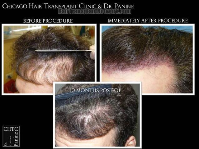 Hair restoration procedure before and after pictures