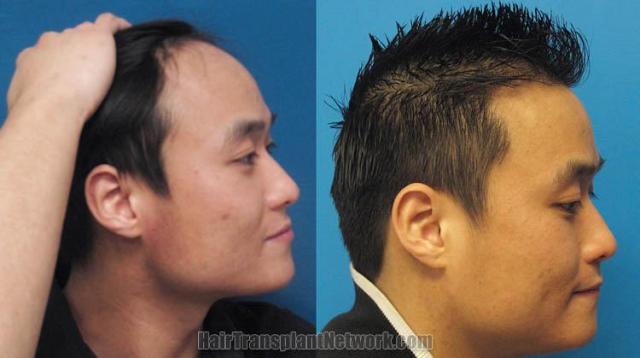 Hair restoration procedure before and after results