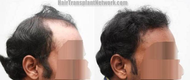 Hair transplantation surgery before and after photos