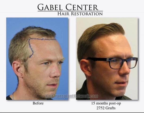 Hair transplantation surgery before and after images