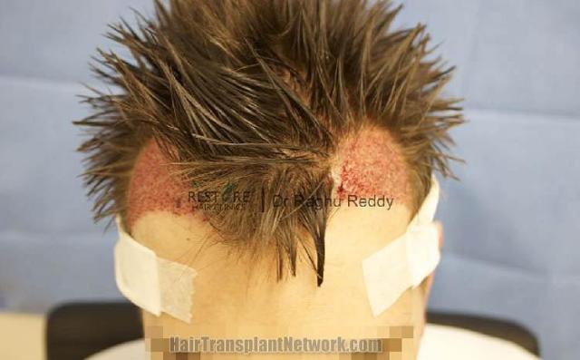 Hair transplantation surgery before and after pictures