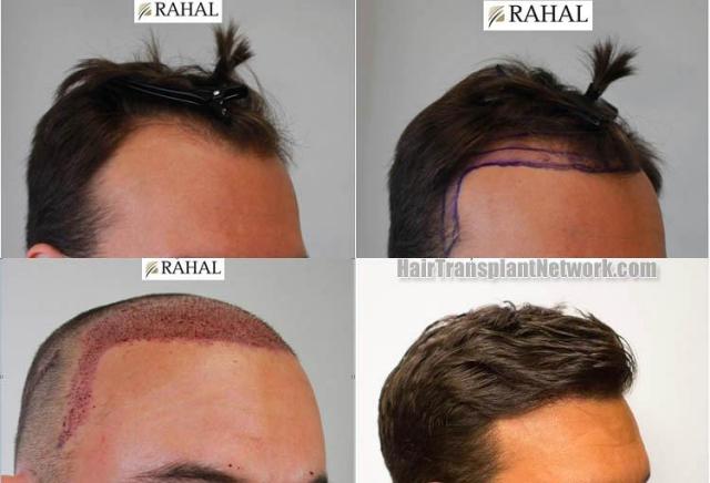 Hair transplantation surgery before and after photos