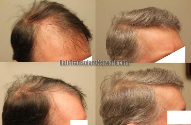 Hair transplantation procedure before and after results