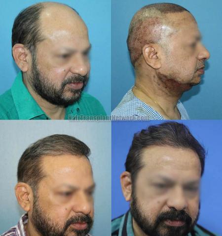 Hair restoration procedure after result images