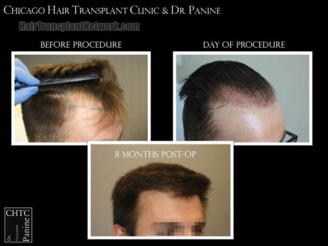 Hair restoration procedure before and after results