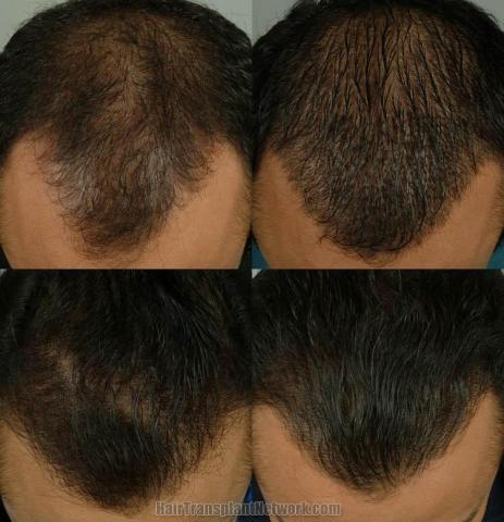 Hair restoration procedure before and after results