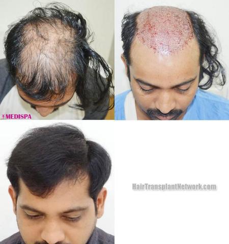 Top view - Before and after hair restoration procedure