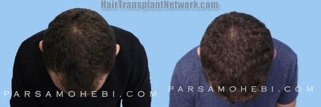 Hair transplantation surgery before and after images