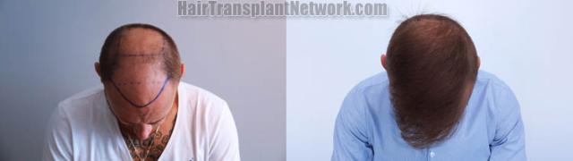 Hair transplantation surgery before and after images