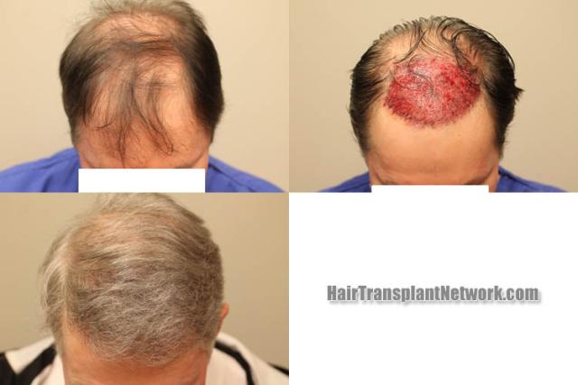 Before and after hair restoration procedure images