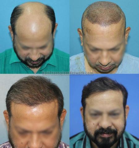 Before and after hair restoration procedure images